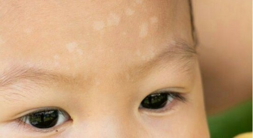 Bercak putih