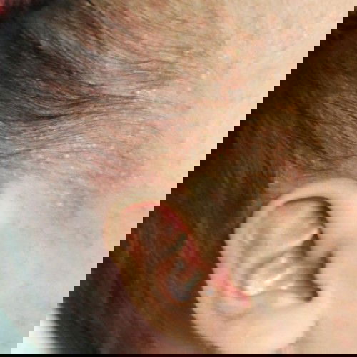 ลูกใครมีผื่นขึ้นแบบนี้บ้างคับ#อากาศที่ห้องร้อนนิดนึง#