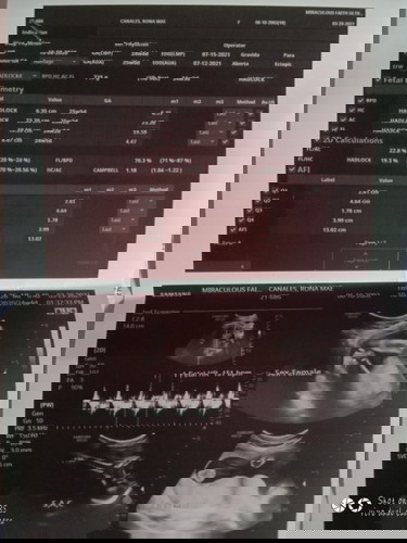 what’s is the meaning of NORMOHYDRAMNIOS? and normal po ba itong ultrasound ko pa advice mga mummy.