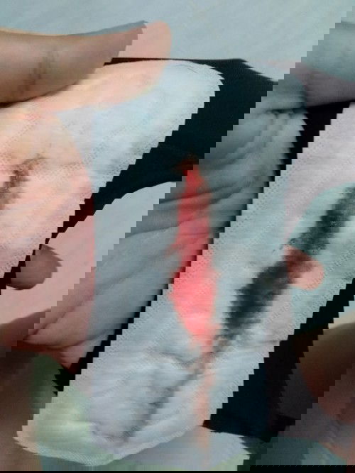 กระตุ้นคลอด กวาดปากมดลูก