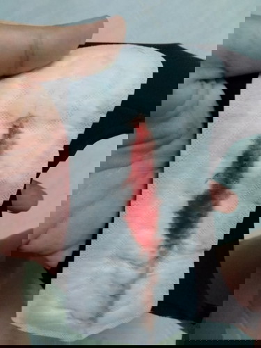 กระตุ้นคลอด กวาดปากมดลูก