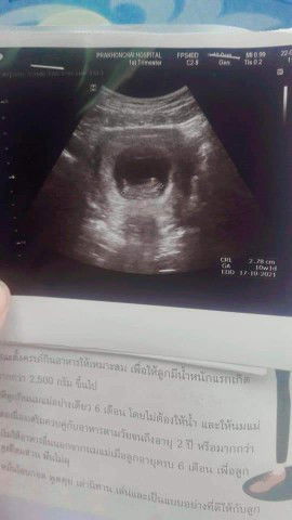 ตอนนี้ท้องได้11w4d จะรู้เพศประมานกี่เดือนค่ะแม่ๆ