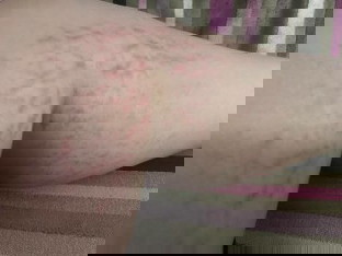 Red lines on both legs/likod ng tuhod