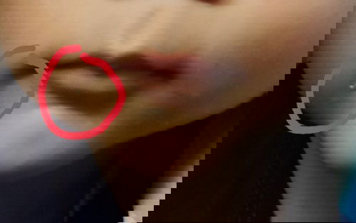 Milia yg tak kunjung hilang