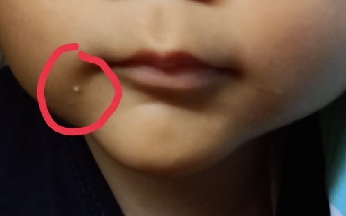 Milia yg tak kunjung hilang