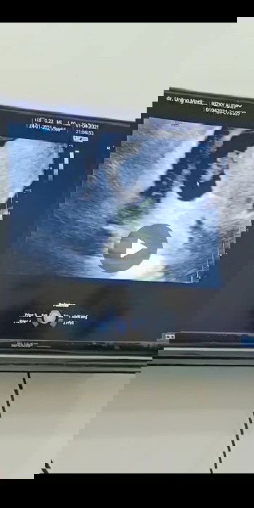 Detak jantung janin hilang