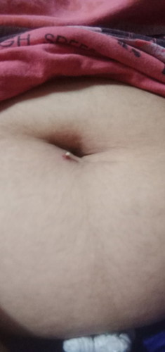 สอบถามผู้รู้.. คือเราทำหมันแล้วแผลมีด้ายขาวๆแบบนี้โผล่มา มันคืออะไร เราจะดึงออกก็ไม่กล้าดึง