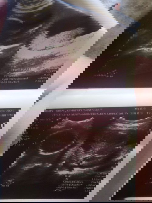 Hi 6 mos po nung nagpaultrasound aq. Suhe pa dw c bby, mukhang girl dw kc wlang egg.