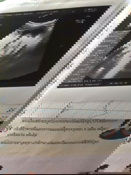 จะออกอยู่เเล้วยังไม่รู้เพศเลยค่ะคุณเเม่ทานไหนดูได้ไหมค่ะกญิงรึชาย