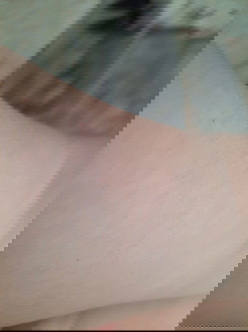 Các môm  cho em hỏi ,em sinh bé gần  3 tháng,các vết nhỏ trên 2 tay vẫn còn chưa hết,cho em hỏi,