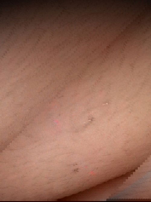 nakagat po ako ng aso ngayon lang .naturokan na po ako ng anti tetano 1 shot . safe po ba kay baby ?