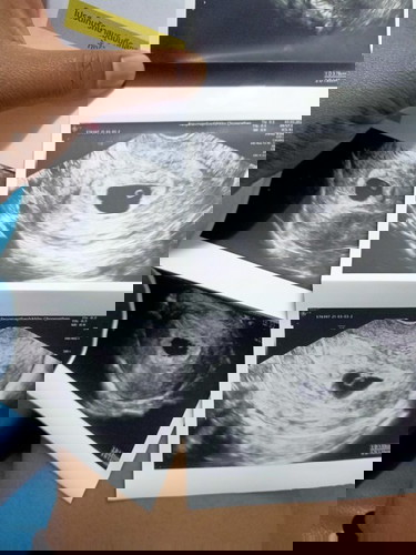 ของเราท้องได้3เดือนอัลต้าซาวไม่เคยเจอตัวเด็กเลยจนหมอบอกว่าท้องลมตอนนี้หมอได้ยุติการต้องครรภ์ไปแร้ว