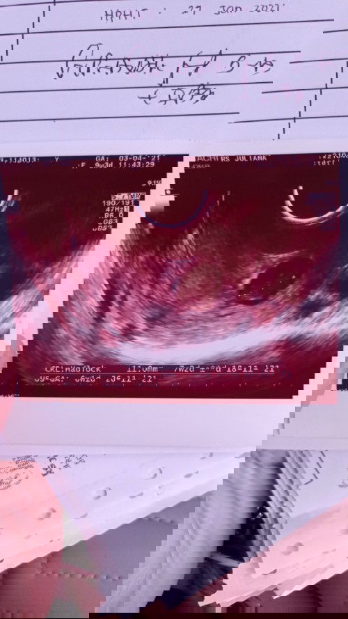 Ternyata Janin sya tidak berkembng dri usia kandungn 7W 😭😭