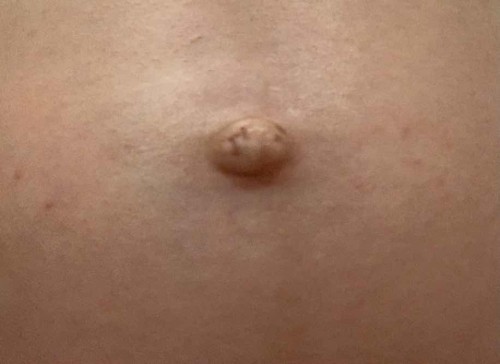 สะดือปูดจนเจ็บ