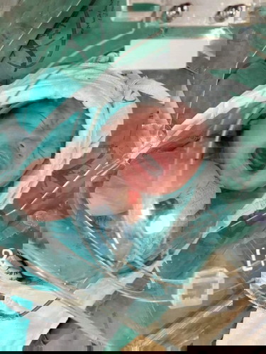 ขอความรู้หน่อยครับลูกผมผ่าคลอดเมื่อวันที่31ที่ผ่านมามีอาการให้ใจเร็วและตัวเหลืองต้องอบน้ำหนัก3590