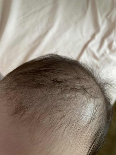 Cradle cap?