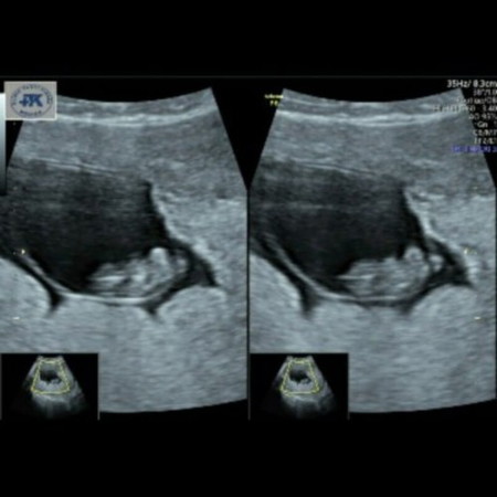 MISSED ABORTION ( Janin meninggal tanpa gejala keguguran )