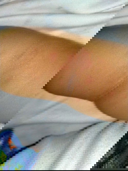 ini alergi atau biang keringat??