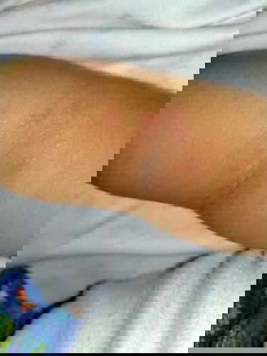 ini alergi atau biang keringat??