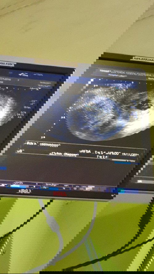 7 วีค u/s เจอแต่ไข่แดง / มีเลือดออกกะปริดกะปรอย