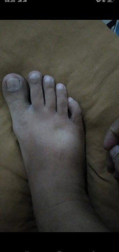 36วีคเท้าบวมกดแล้วบุ๋ม