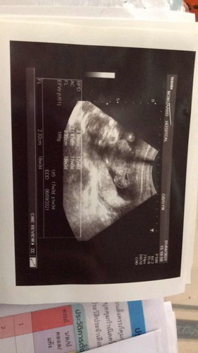 อายุน้อยแต่มีความเสี่ยงดาวน์ซินโดมสูงต้องไปเจาะน้ำคร่ำคือกังวลมากเลยคะกลัวน้องจะเป็น🥺