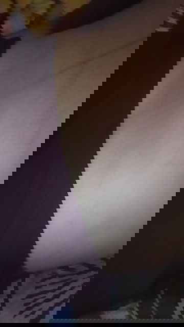 Panas perih di area bawah payudara