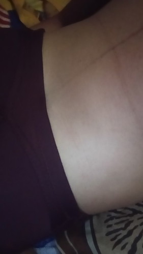 Panas perih di area bawah payudara