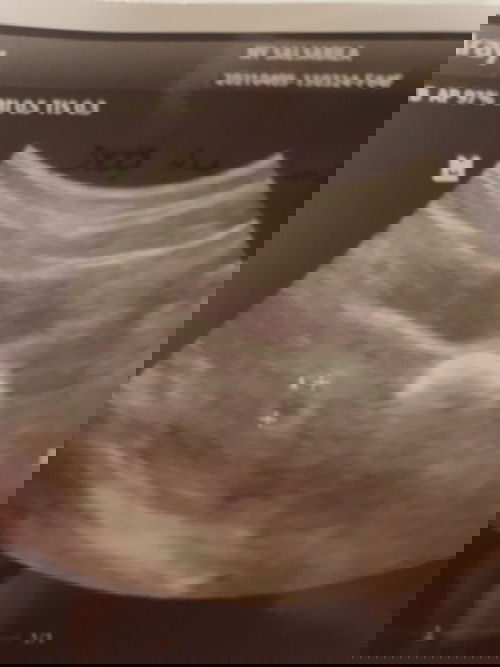 sudah 6 weeks tapi kantung masih kecil, normal?