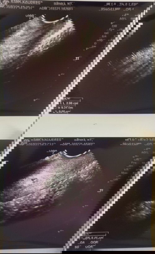 Keluar gumpalan darah sebesar ujung jari telunjuk kecil