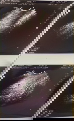 Keluar gumpalan darah sebesar ujung jari telunjuk kecil