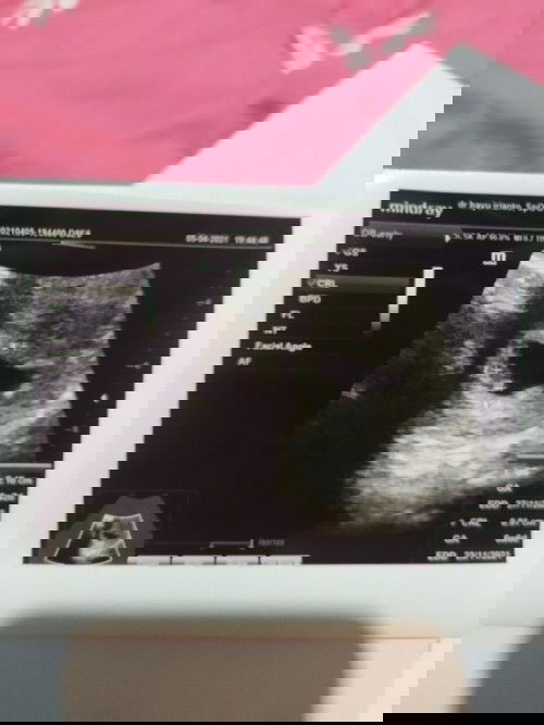 Bund kalo hasil usg 6w6d