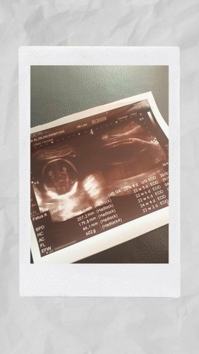 Ini hasil usg ku.Belum terlihat muka dan jenis kelaminnya.
Karna posisi bayi membelakangi.Wajar bun?