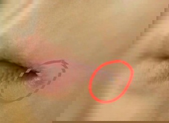 Angular cheilitis
