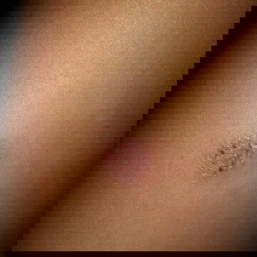 พอดียุงกัดแล้วไปเกาก็มันเป็นแบบนี้เลยค่ะ แม่ๆเคยเป็นเเบบนี้ไหม ควรใช้อะไรทาดีคะ แนะนำหน่อยค่ะ???????