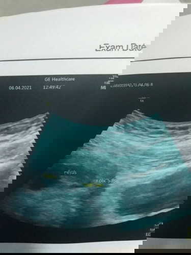 มีแม่ๆคนไหนมีภาวะแท้งคุกคามบ้างค่ะ
จะหายไหม เป็นมาตั้งแต่6wจนตอนนี้ 8w แล้วยังมีมูกสีน้ำตาลอยู่เลยแต่ไม่ได้ออกทุกวันเป็นบางวันค่ะ  แต่คุณหมอบอกน้องปกติดี