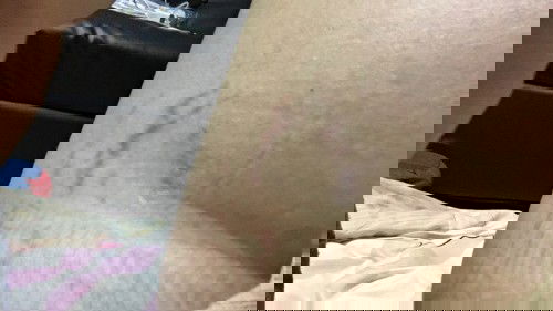 ท้องแตกลาย ใช้ครีมอะไรดีคะ