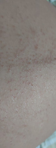 Hi ask ko lang po.. do you have rashes in your belly.. ano pong ginawa nio?.. ang kati ksi.