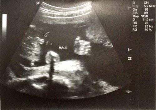 Anong gender ni baby? At ilang weeks kayo ng pa ultrasound Mommy?