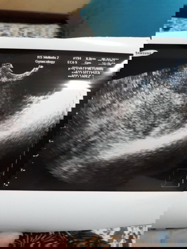 Bun, kalau di umur 5 minggu sprti ini, janin belum kelihatan baru penebalan saja apakah wajar ?