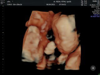 Bayi kembar,yang satu meninggal dalam rahim