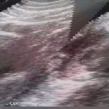 ini usg kmren. usia kndunganya skrg 9 mngg. tp kata dkternya blm keliatan jelas byk lemak dperut.