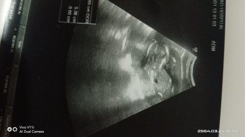 ช่วยดูเพศลูกน้อย