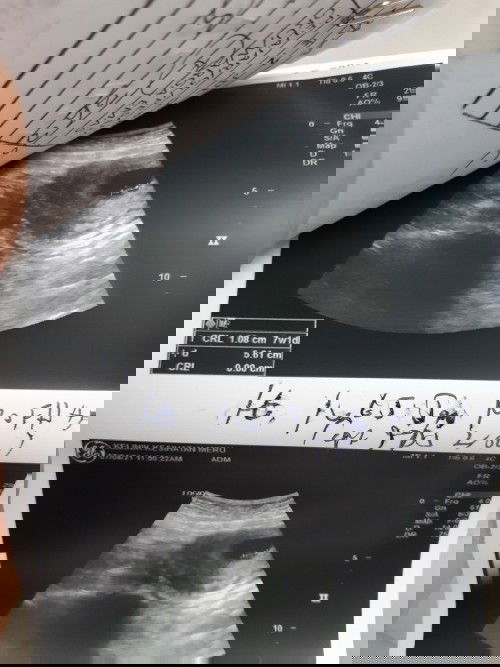 Baby Tak Ada HeartBeart