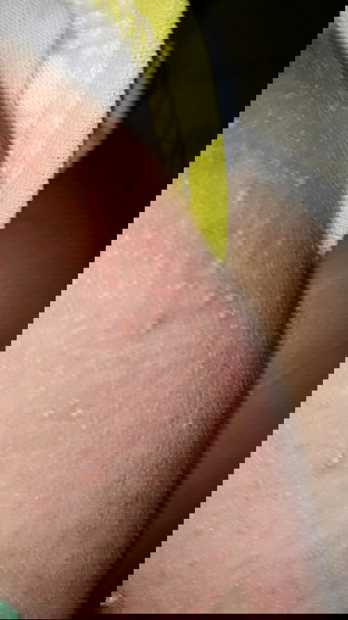 Bintik merah semua tubuh