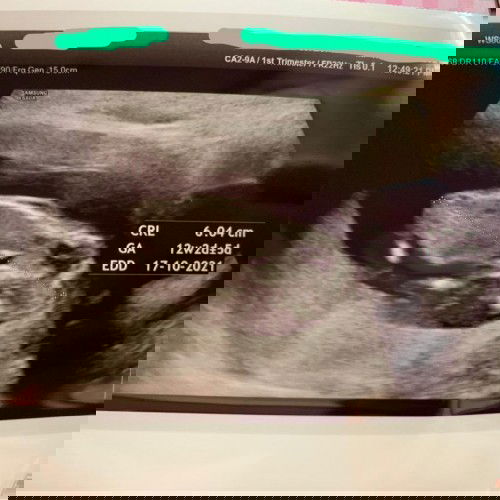 Baby facing down in ultrasound week 11, 6 days