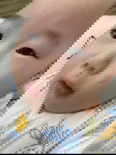 Red Spot on the face