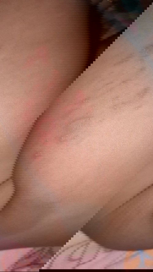 Melepuh dan bintik bintik