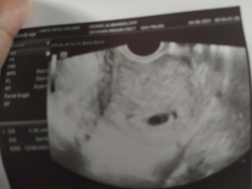 EARLY PREGNANCY QUESTION