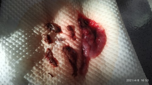 Akhirnya saya keguguran 😭
Hamil anak k3, abortus yg ke 8x